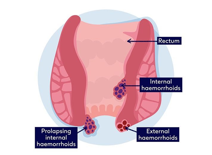 What are haemorrhoids Boots