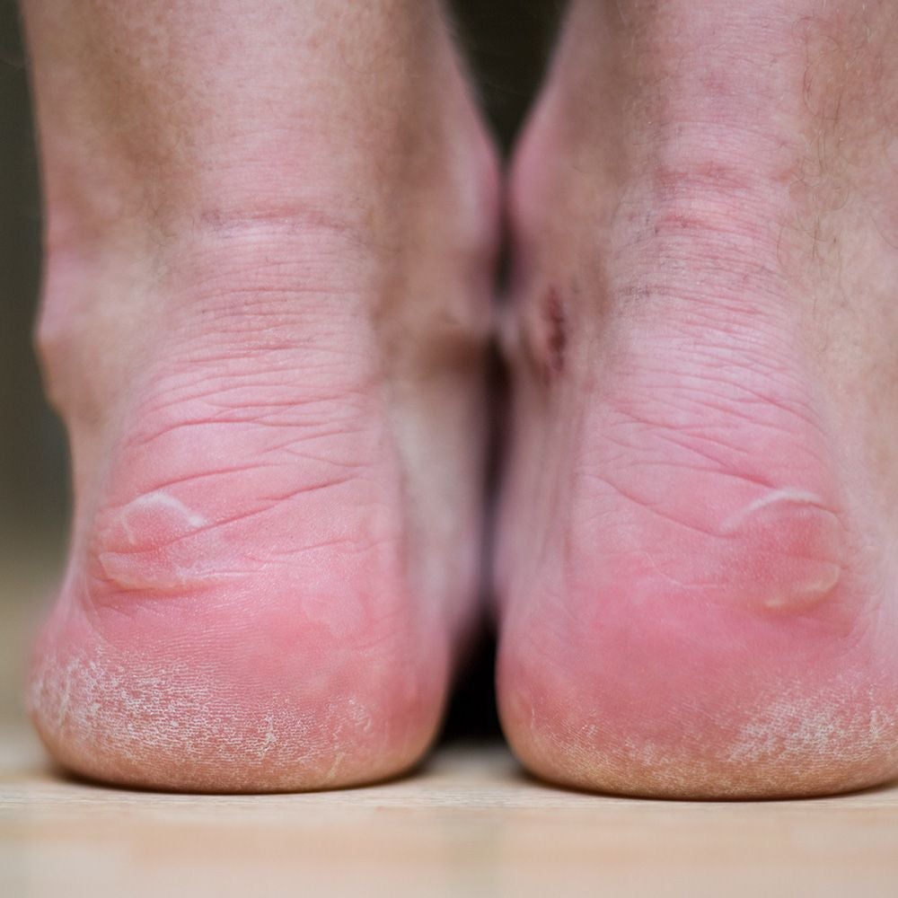 Blisters Boots