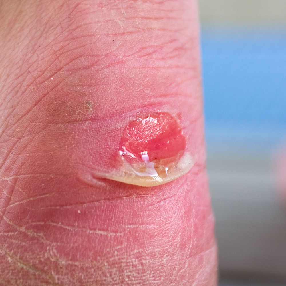 Red blister top