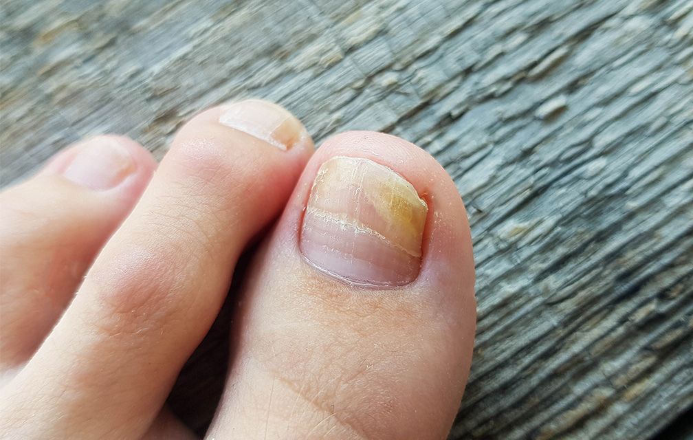 Fungal on sale toenail treatment