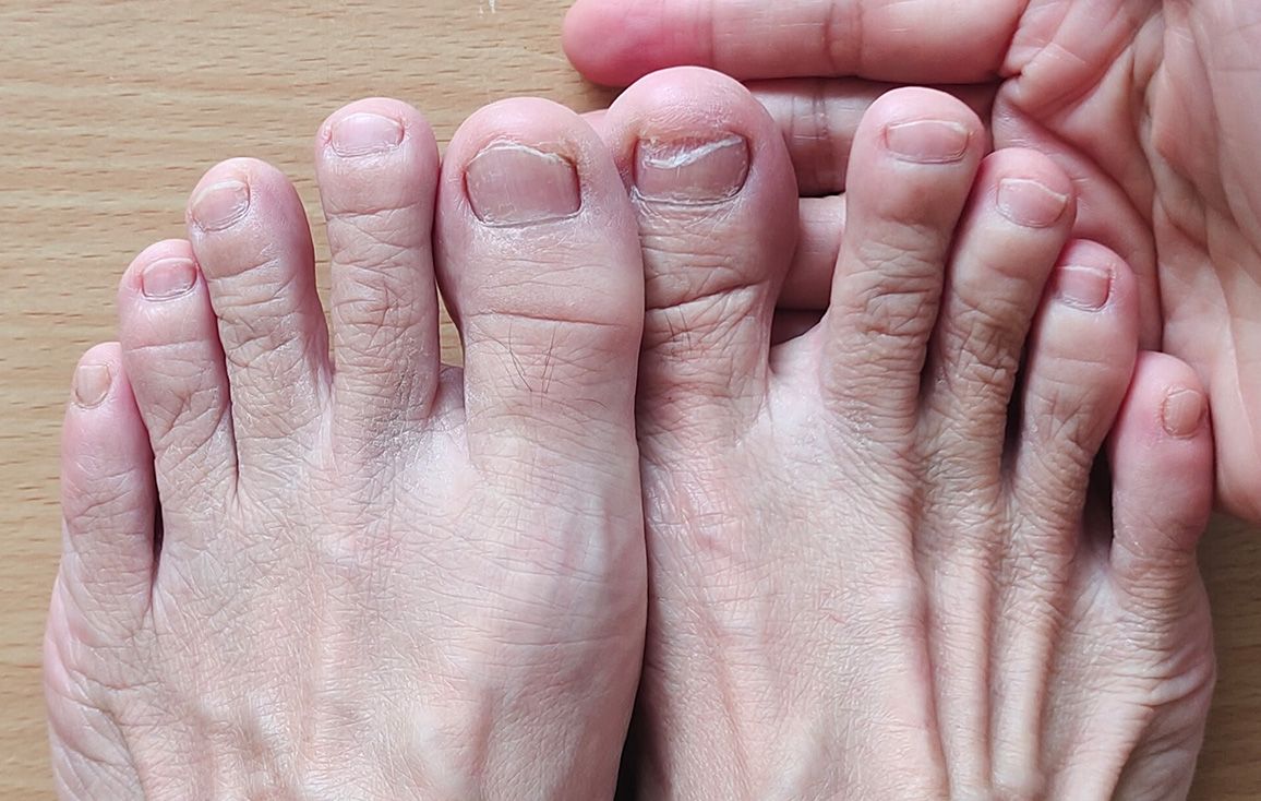Causes of Curled Toenails - Feet First Clinic