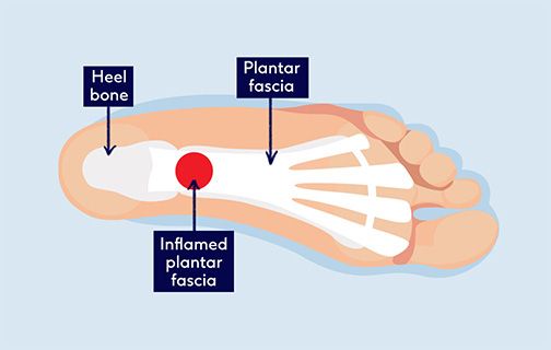 Plantar pain ball of on sale foot