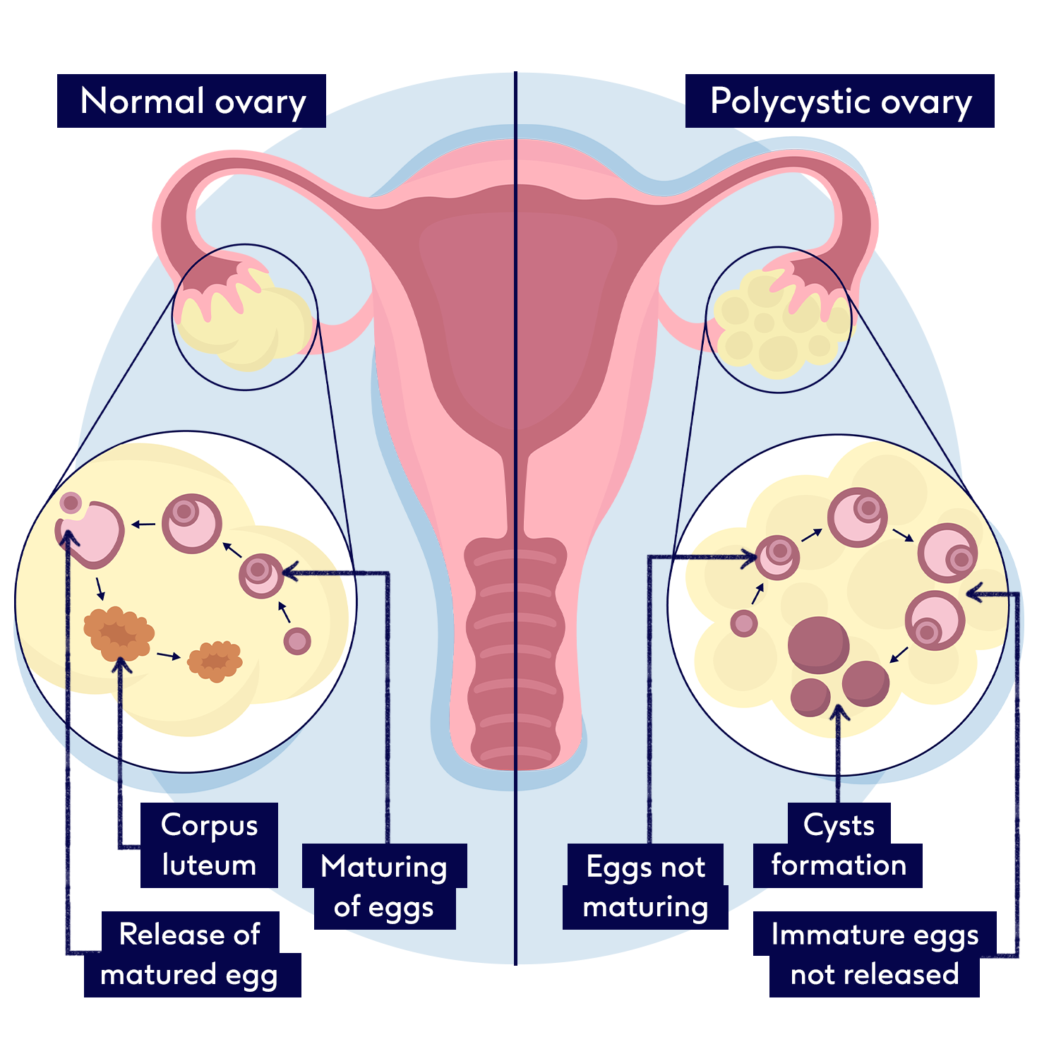 Polycystic ovary syndrome   Boots Health Hub