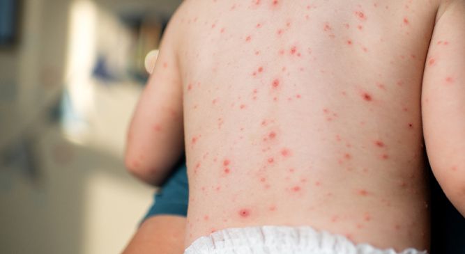 What is chickenpox & how to treat it? - Boots Health Hub