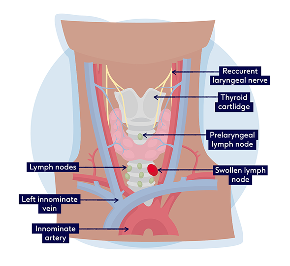 Blisters in outlet back of throat
