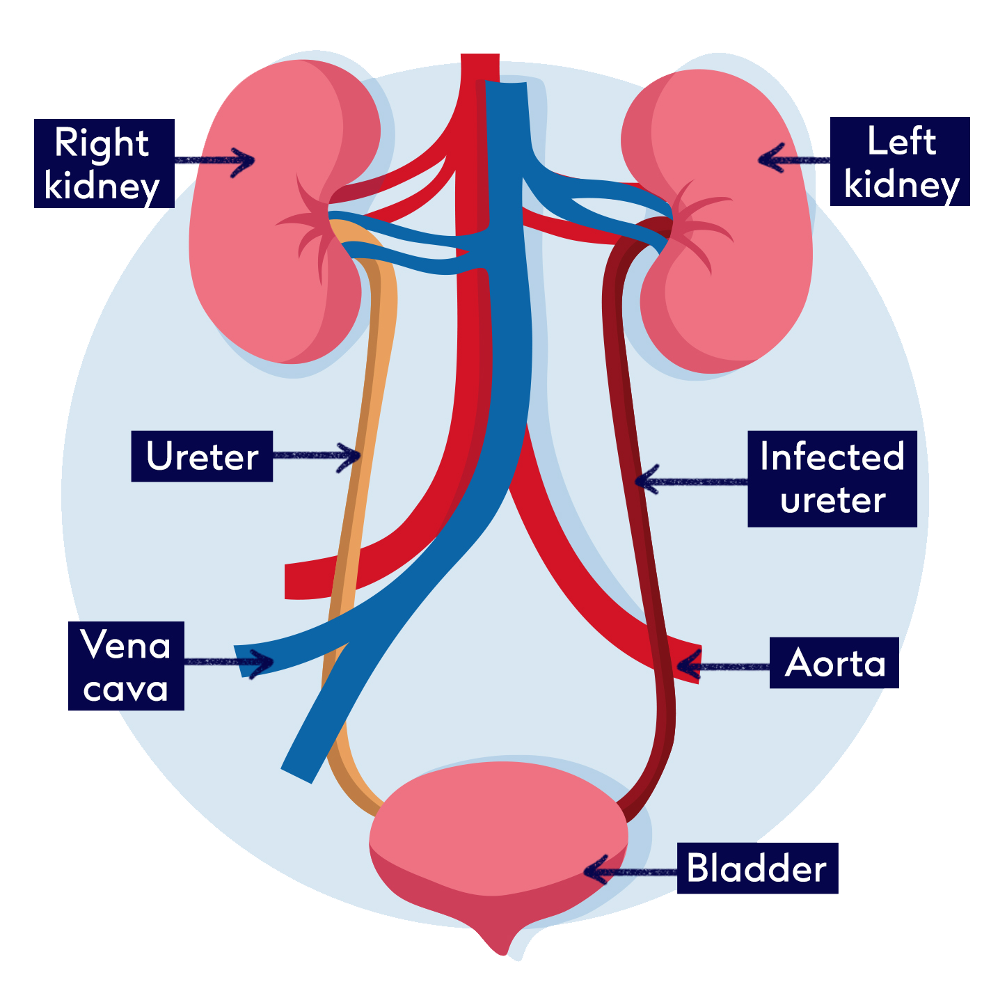 What is cystitis how to treat it Boots Health Hub