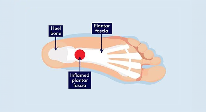 Understanding plantar fasciitis Boots