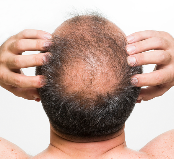 Male Pattern Baldness